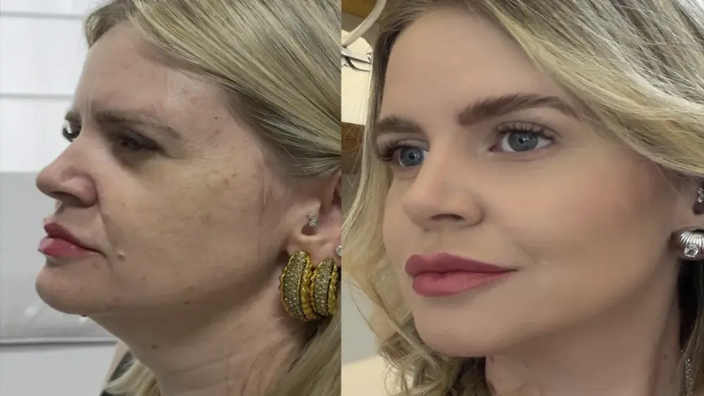 Estética regenerativa: o novo luxo vai além dos preenchedores